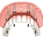 All-On-4 Dental Implants Chula Vista