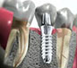 Mini Dental Implants Chula Vista